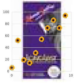 Chromosome 1, monosomy 1q25 q32